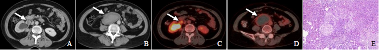 右肾门旁异位肾上腺腺瘤伴腹膜后血肿18F-FDGPET/CT显像1例