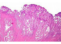 <font color="red">抗体</font>药物偶联物Trodelvy显著改善三阴性乳腺癌患者的PFS：III期研究达到终点