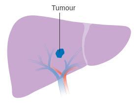 Keytruda联合Lenvima治疗肝细胞癌（HCC）：遭遇滑铁卢