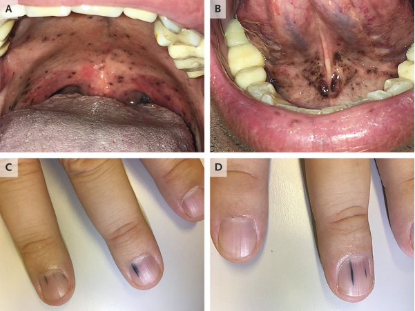 NEJM：粘膜和手指黑色素瘤转移-病例报道