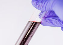 Clin Chem：在液体<font color="red">活检</font>中，血浆或血清哪一种更适合突变检测?