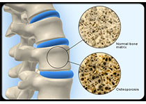PNAS：新研究有助于治疗骨质疏松