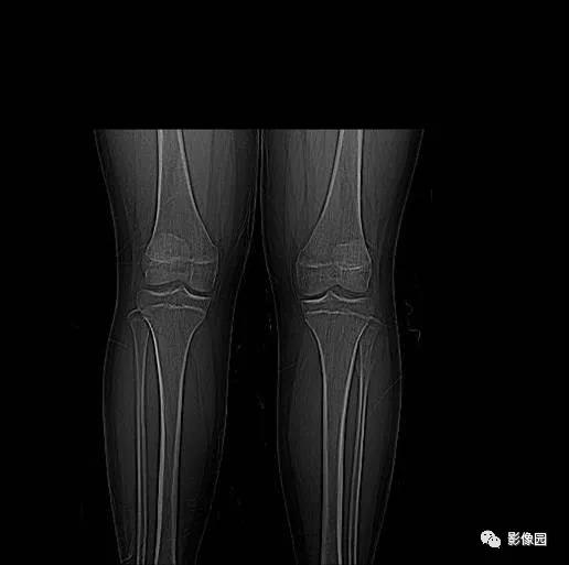 女性，左小腿上段疼痛一月，请诊断！