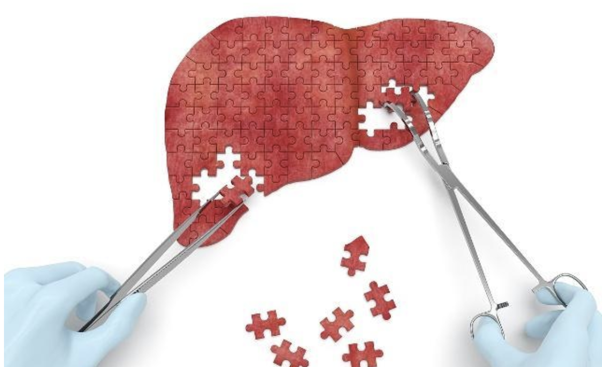 Dig Liver Dis: 自身免疫性肝炎患者血清免疫球蛋白G水平正常化与无移植生存期改善有关