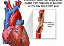 Heart：D-二聚体与急性心肌梗死后心衰发生率和死亡率的关系