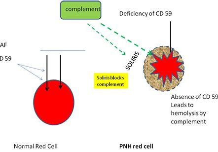 EBMT 2020：LNP023治疗阵发性夜间血红蛋白尿（PNH）取得积极结果