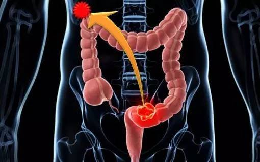 J Gastroenterology：<font color="red">大肠</font>癌原发<font color="red">肿瘤</font>位置对患者预后的影响