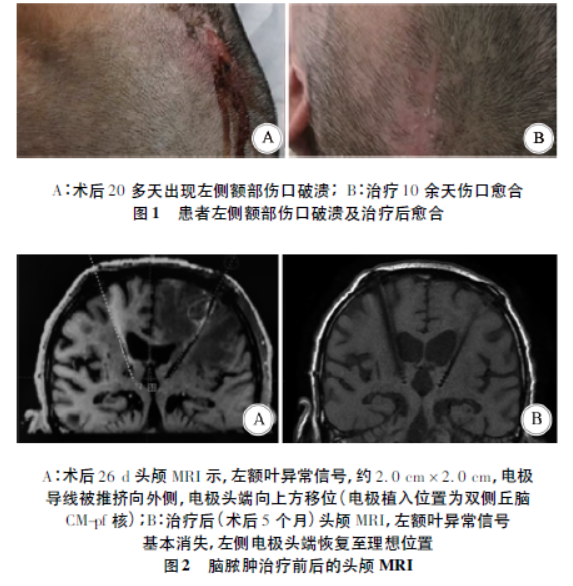 植物状态患者脑深部电刺激术后脑脓肿1例报告并文献复习