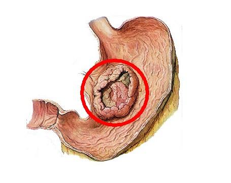 Gastric Cancer:源自肥大细胞的白介素-17A通过腹膜扩散促进胃癌的纤维化