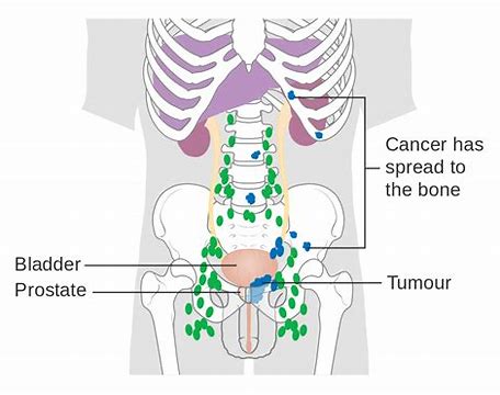 NEJM：Nubeqa（darolutamide）显著延长非转移性前列腺癌患者的寿命！