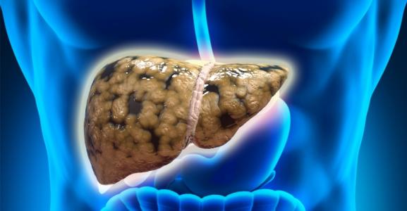 Liver Int：氧化应激与健康人群的非酒精性脂肪肝疾病发生率和死亡率相关