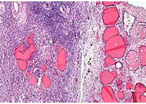 Lancet：阿特珠单抗用于早期三阴性乳腺癌的辅助化疗