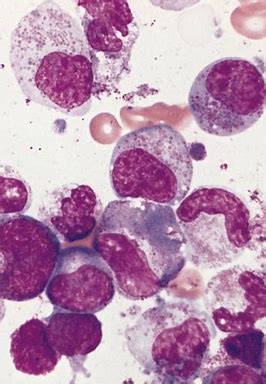 FDA批准Nucala在美国治疗高嗜酸性粒细胞综合征（<font color="red">HES</font>）