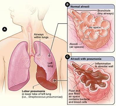 雾化Ensifentrine治疗慢性阻塞性肺疾病（COPD）：即将开展<font color="red">III</font>期临床试验