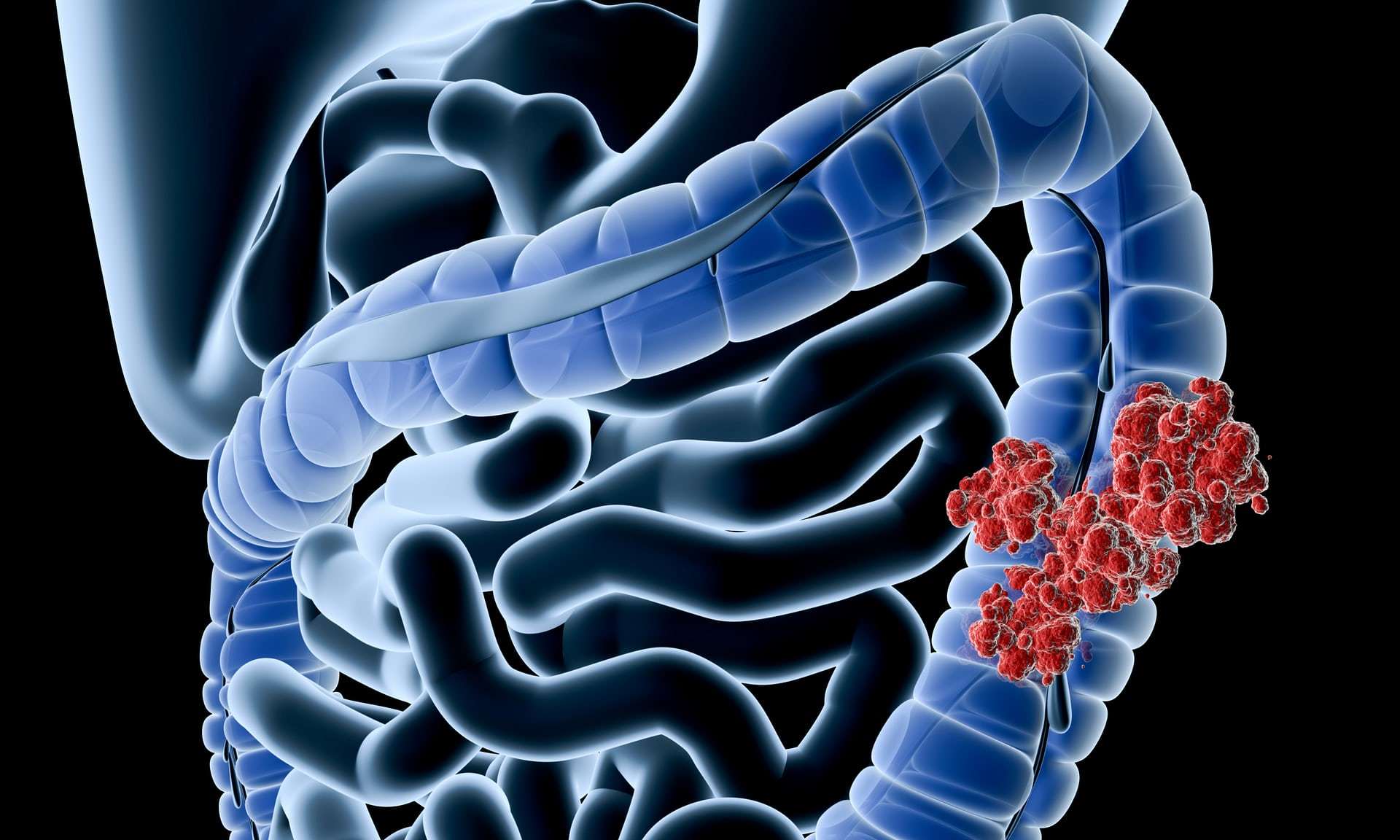 使用类器官了解结直肠癌的机制和进展 - Crown Bioscience