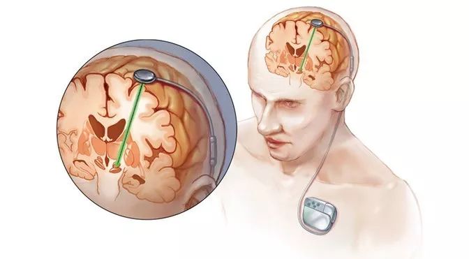 JNNP：丘脑底核脑深部刺激治疗冲动性和强迫性行为患者的早期预后影响因素