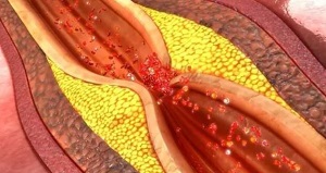 JAMA Cardiol：他汀类<font color="red">药物</font>治疗与冠脉粥样硬化斑块进展的关系