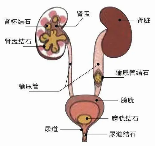 Kidney Int：术前识别<font color="red">泌尿系</font>感染性结石真的很困难吗？这个模型做到了！