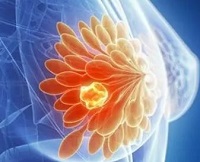 Clin Cancer Res：尼拉帕利在携带BRCA1/2胚系突变的晚期乳腺癌的疗效