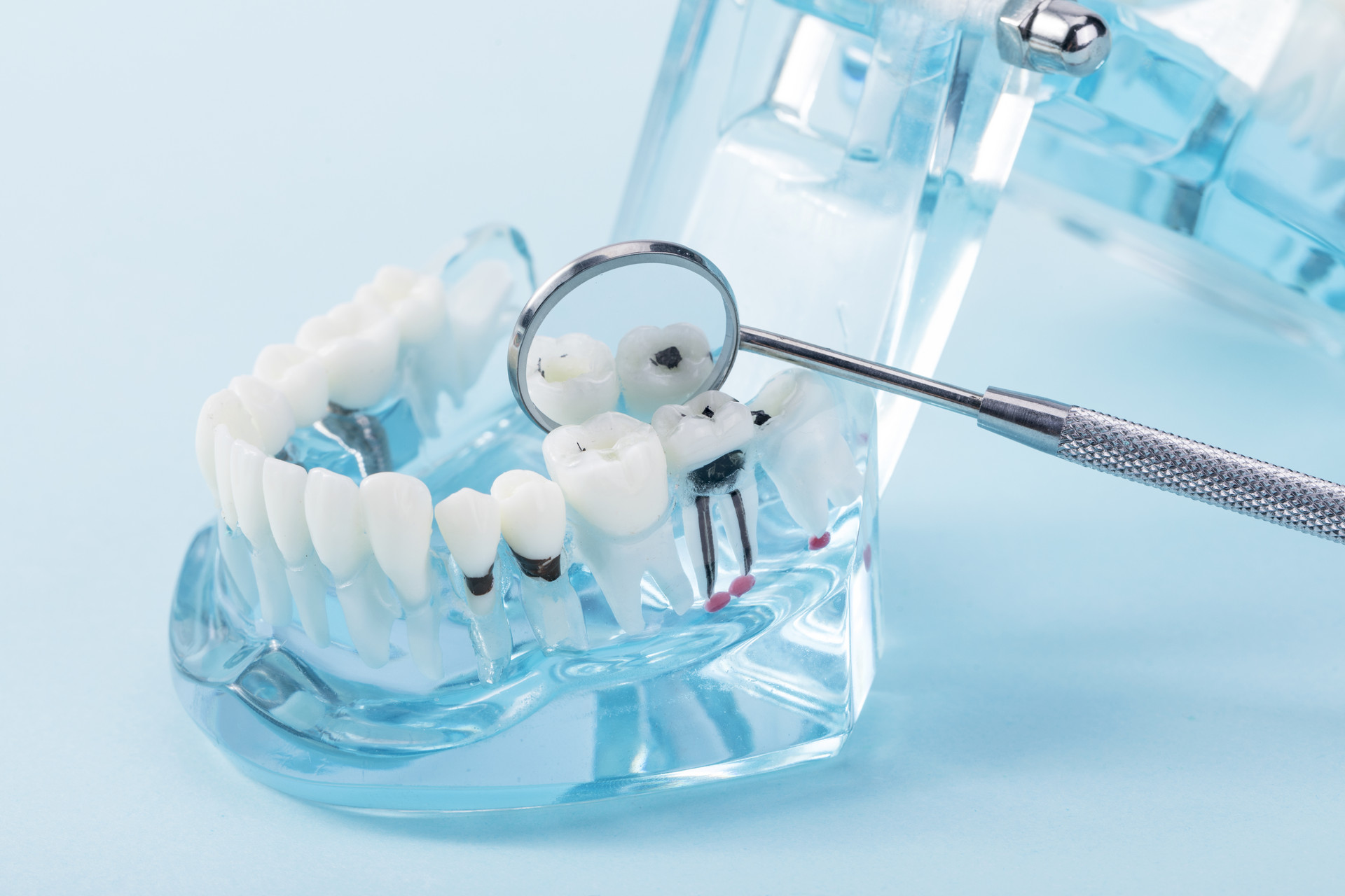 J Clin Periodontol：不同富含血小板的纤维蛋白基质对多颗牙齿拔除术中牙槽嵴位点保存的作用