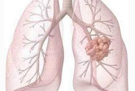 <font color="red">Clinical</font> Lung <font color="red">Cancer</font>：HER2基因改变在EGFR突变型非小细胞肺癌（NSCLC）中的作用