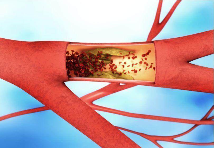 IBD: 炎症性肠病患者和<font color="red">静脉血栓</font>栓塞患者抗凝治疗期间大出血的风险比较