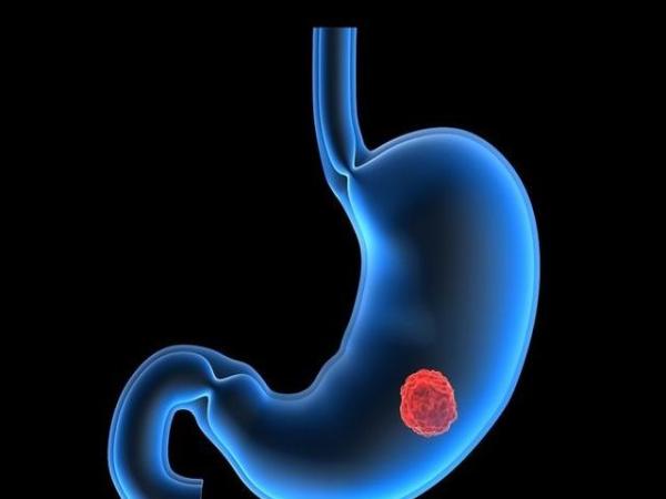 Clinical Translational Gastroenterology：80岁以上老年胃癌内镜黏膜下剥离术术后出血的危险因素分析