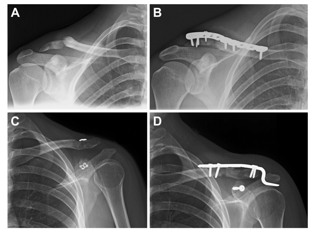 AJSM：喙突或锁骨骨折与喙锁骨韧带重建术的相关性