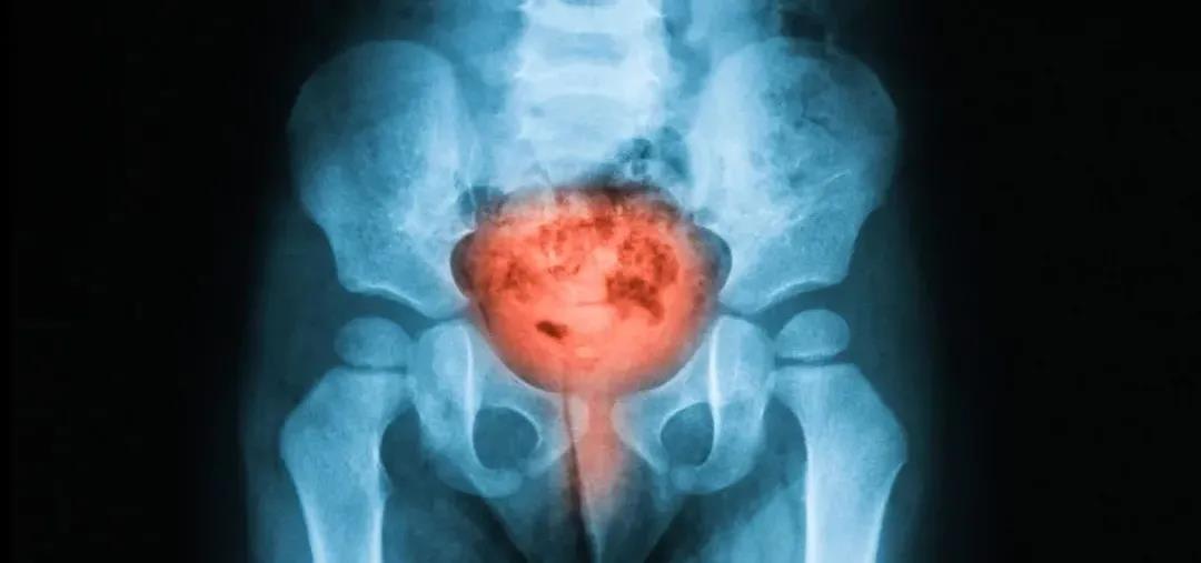 Journal of Urology：上海交大陈海戈团队重磅成果：仅需几毫升尿液即可无创精准诊断膀胱癌