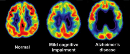 Alzheimer&Dementia：癌症不是万恶的，居然还能降低<font color="red">痴呆</font><font color="red">风险</font>！
