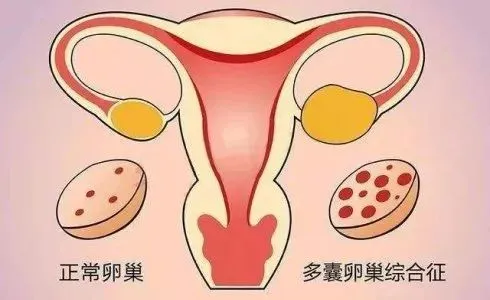 FERTIL STERIL：多<font color="red">囊</font>卵巢患者的福音，方便准确的血清AMH检查来了！