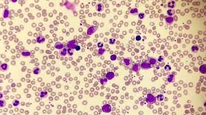 FDA 批准Scemblix（asciminib）治疗慢性粒细胞<font color="red">白血病</font>