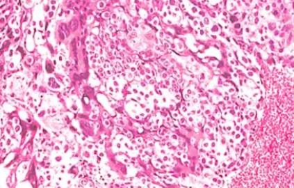 Lancet Oncol：卡瑞珠单抗联合阿帕替尼有望成为化疗难治性/复发性妊娠滋养细胞肿瘤的<font color="red">挽救治疗</font>方案！