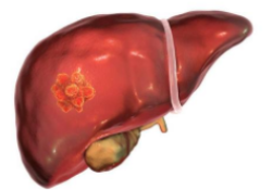 Front Oncol：<font color="red">肝硬化</font>严重程度对肝细胞癌患者进行手术(LR)和微波消融(PMCT)治疗的影响