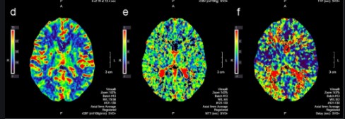 JAMA Neuro：延长<font color="red">时间</font><font color="red">窗</font>的大动脉闭塞脑卒中，选CT、CTP还是MRI?