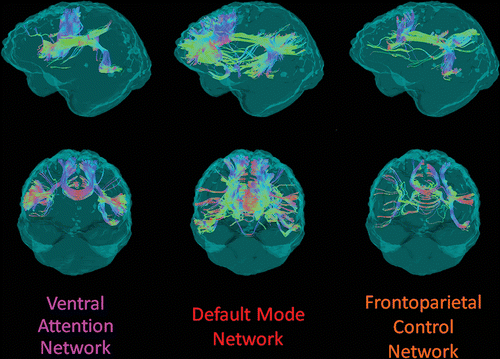 Radiology:DTI有助于<font color="red">识别</font>具有早发性AD遗传风险者大脑结构变化