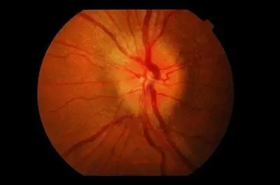 JNNP:多发性硬化诊断中的视网膜眼间差异和萎缩进展