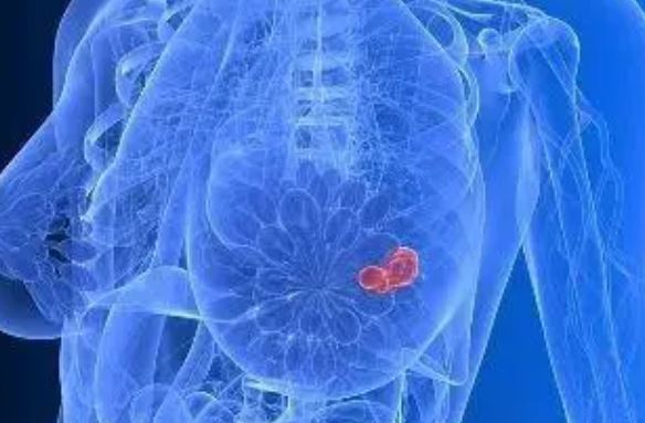 Clin Cancer Res：纳武单抗联合伊匹单抗治疗晚期化生性乳腺癌