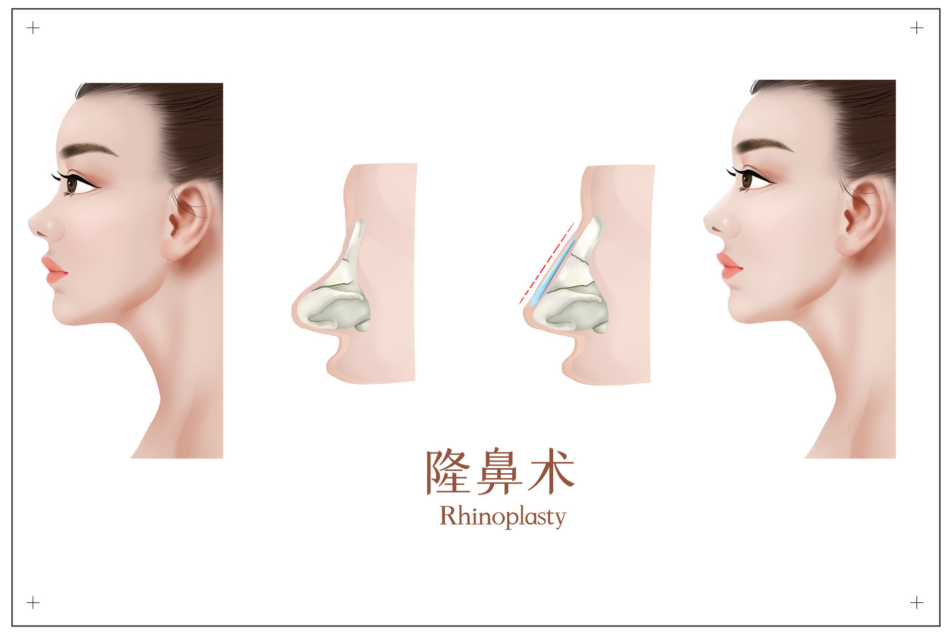 内入路保留鼻整形丨歪鼻矫正+小切口面部提升