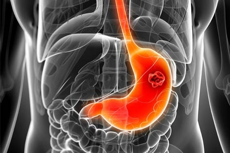 Gastric Cancer: 胃癌出血患者接受姑息放疗后的治疗效果分析