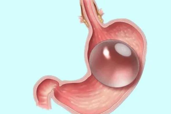 Lancet：代替缩胃手术，采用可调节的胃内球囊进行减肥的效果