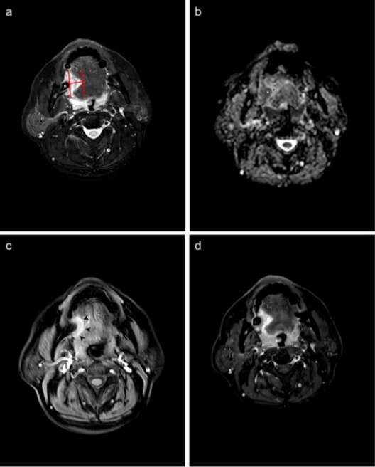 European Radiology：多参数MRI评估<font color="red">口腔</font>舌鳞状细胞癌的肿瘤浸润深度