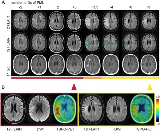 Brain：TSPO PET有助于监测及<font color="red">鉴别</font>进行性多灶性脑白质病