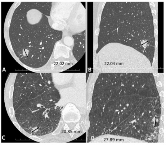 European Radiology:眼见不一定为实：严重肺气肿患者的CT图像可能低估肿瘤的真实大小！