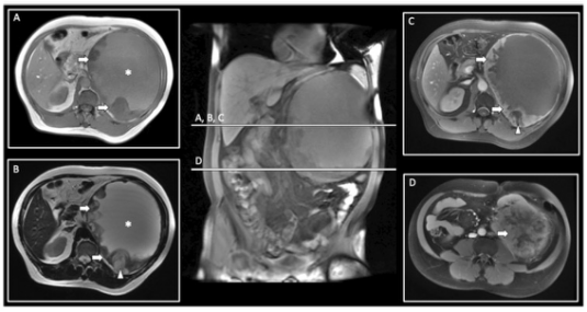 European Radiolog:原发性肾脏肉瘤你见过吗？来看看都有什么特别的影像学特征