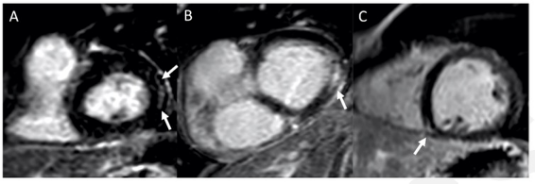 Radiology:对于新冠病毒感染后仍有症状的患者，心脏MRI会给我们什么提示？