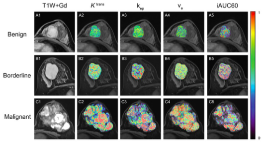 European Radiology：定量<font color="red">动态</font>增强MRI对乳腺纤维上皮<font color="red">肿瘤</font>不同组织学分级的评估