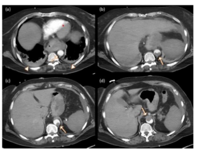 Radiology：对于COVID-19住院患者来说，肺栓塞并不仅仅是肺栓塞！