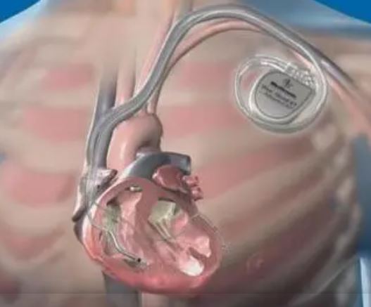 JACC：植入式心律转复除颤器降低长QT间期综合征患者死亡风险的效果