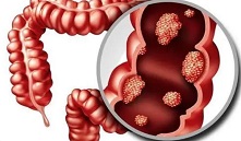 Lancet Gastroenterol Hepatol：<font color="red">大便</font>免疫组化检测筛查计划前后的结直肠癌发病率、死亡率、分期和治疗